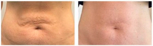 Resultados de endolift en el abdomen