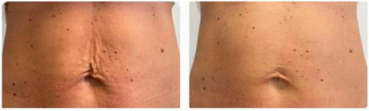 Resultados de endolift en el abdomen