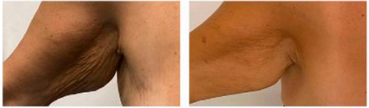 Resultados de endolift en la cara interna del brazo