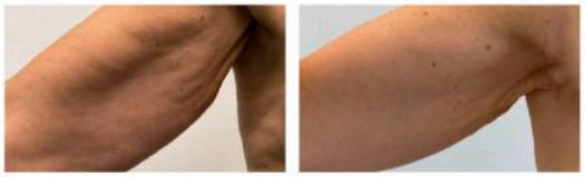 Resultados de endolift en la cara interna del brazo