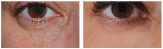 Resultados de endolift en el párpado inferior